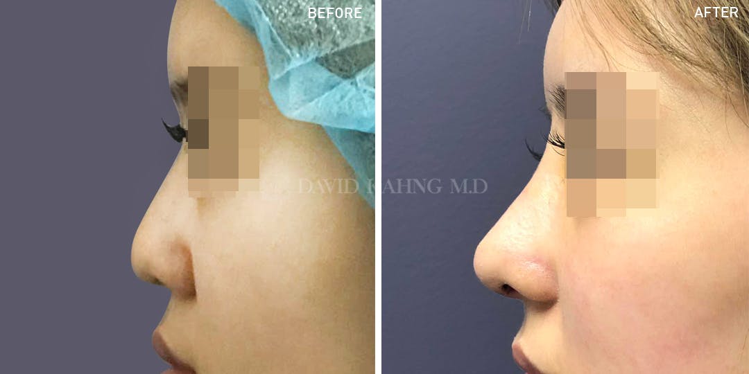 Rhinoplasty Before & After Gallery - Patient 148072240 - Image 1