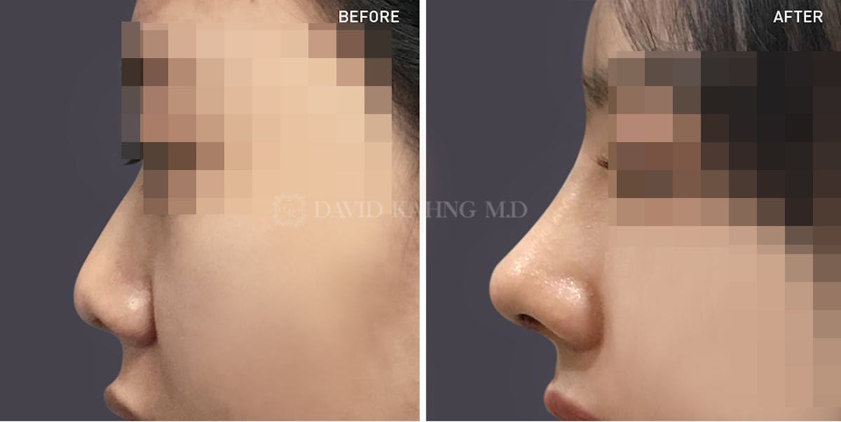 Rhinoplasty Before & After Gallery - Patient 148072239 - Image 1