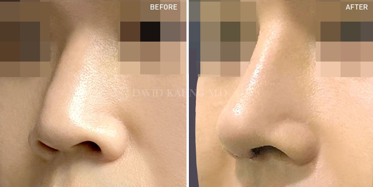 Rhinoplasty Before & After Gallery - Patient 148072238 - Image 1