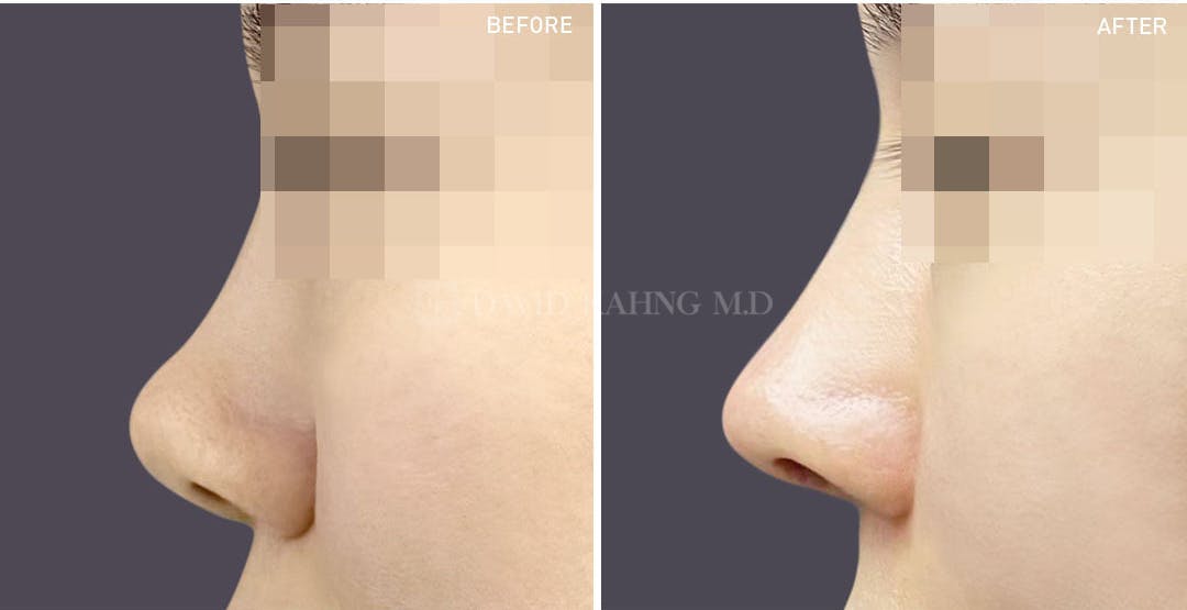 Rhinoplasty Before & After Gallery - Patient 148072237 - Image 1