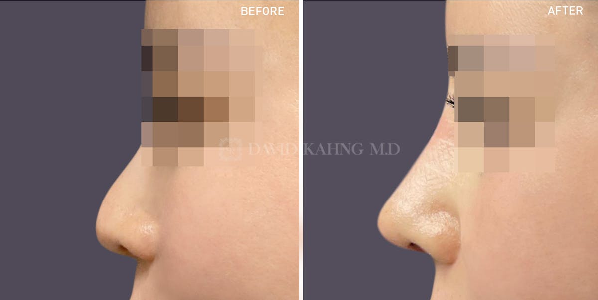 Rhinoplasty Before & After Gallery - Patient 148072236 - Image 1
