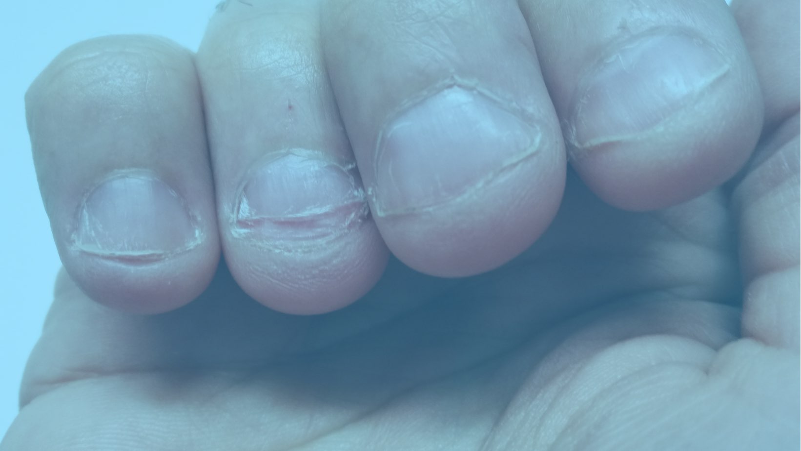 Woman Warns People Not To Bite Nails After Friend Gets Serious Infection
