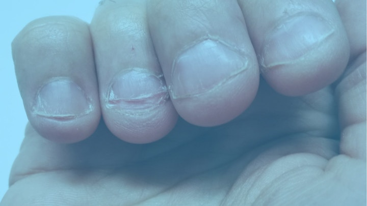 Nail Biting Infection: What Is It, Causes, and Treatment 