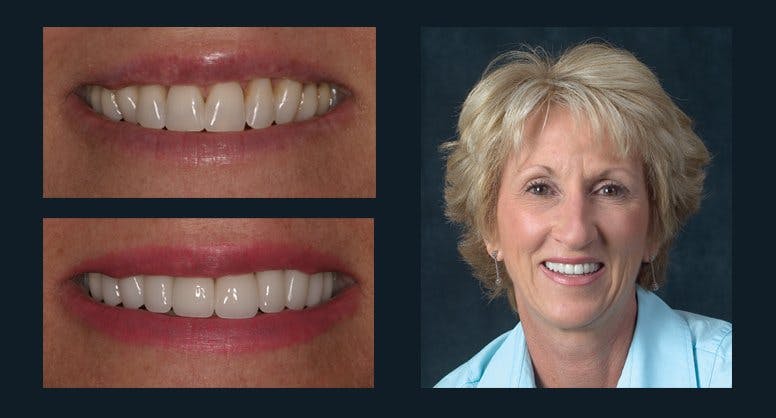 Smile Before & After Gallery - Patient 94064465 - Image 1