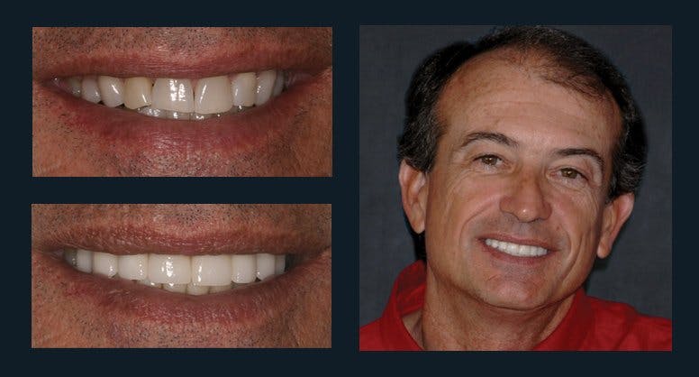 Smile Before & After Gallery - Patient 94064464 - Image 1
