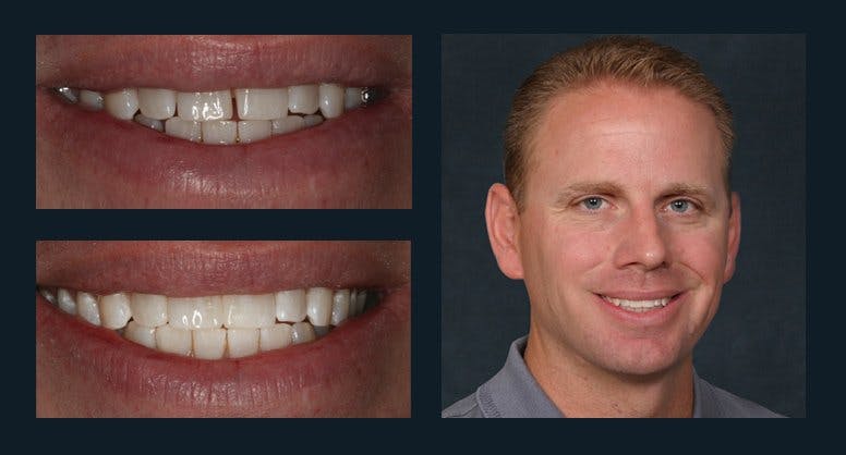 Smile Before & After Gallery - Patient 94064463 - Image 1