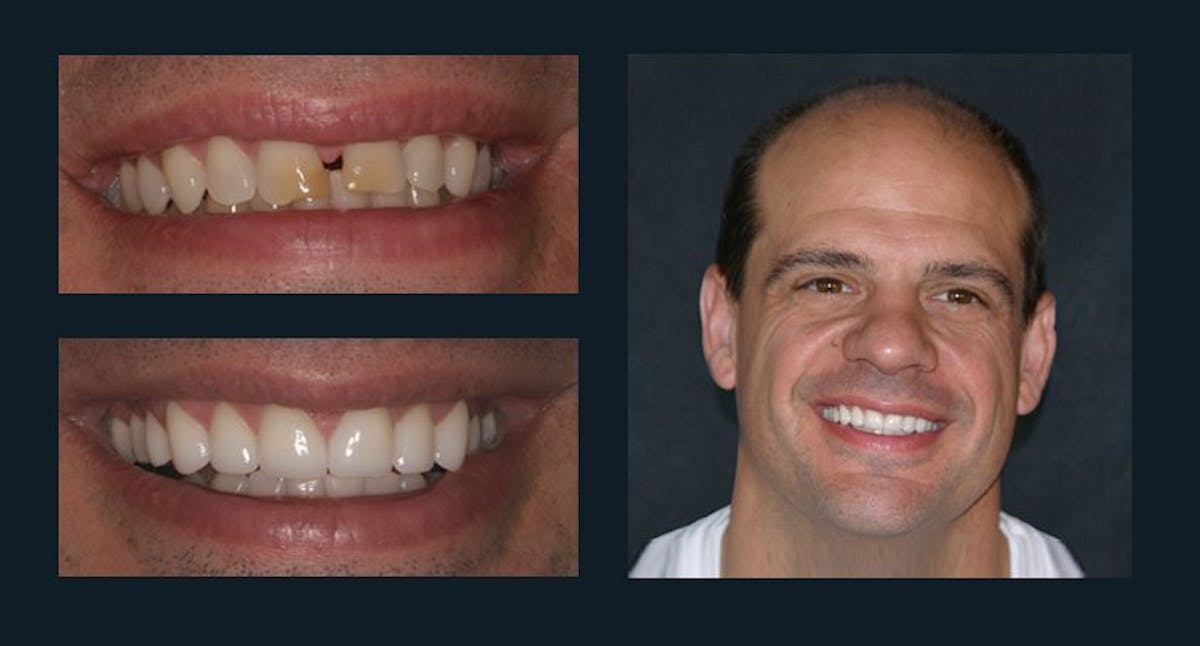 Smile Before & After Gallery - Patient 94064462 - Image 1