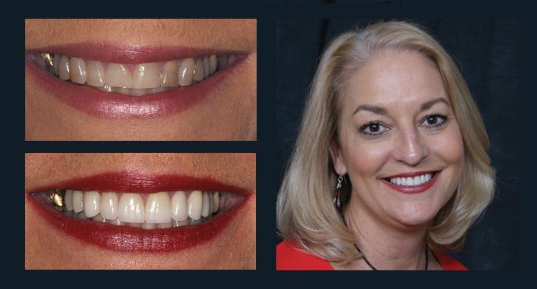 Smile Before & After Gallery - Patient 94064461 - Image 1