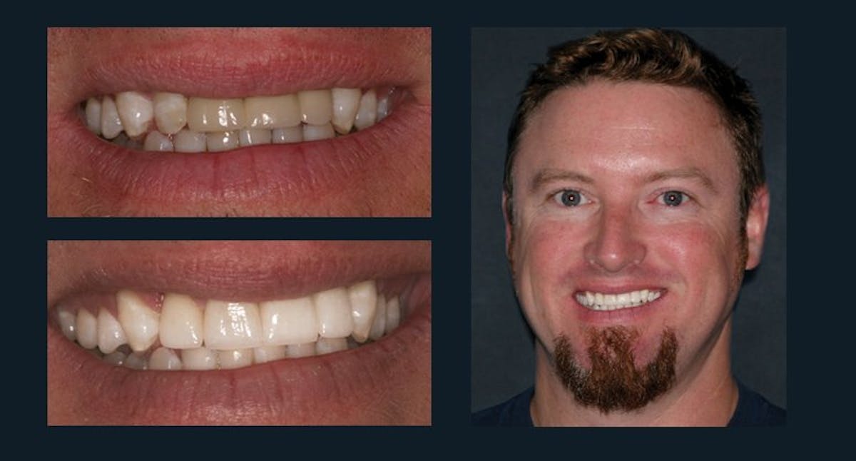 Smile Before & After Gallery - Patient 94064460 - Image 1