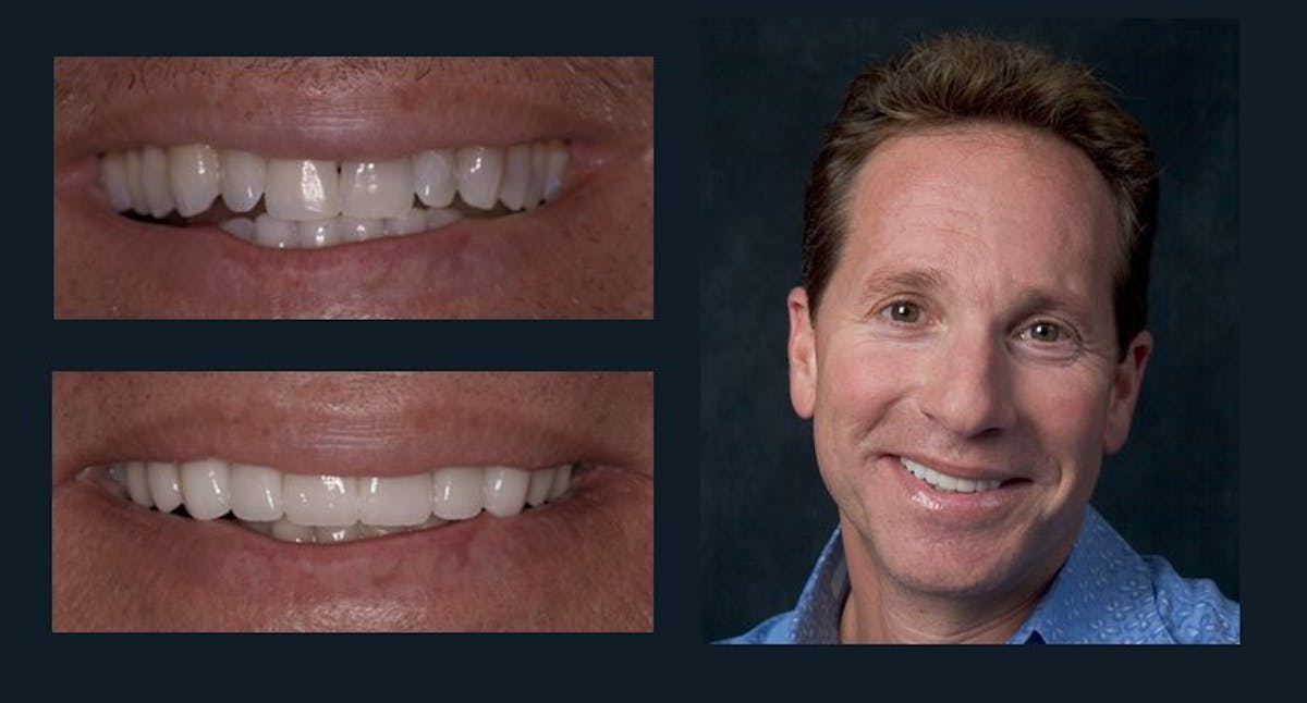 Smile Before & After Gallery - Patient 94064459 - Image 1