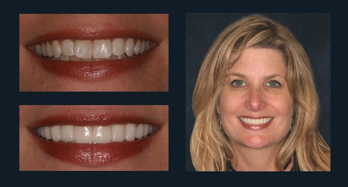 Smile Before & After Gallery - Patient 94064458 - Image 1