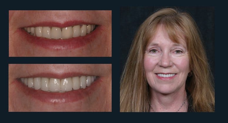 Smile Before & After Gallery - Patient 94064456 - Image 1