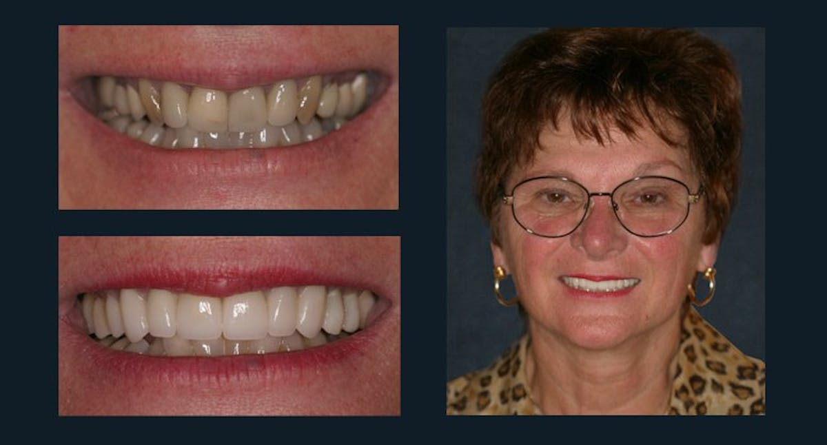 Smile Before & After Gallery - Patient 94064454 - Image 1