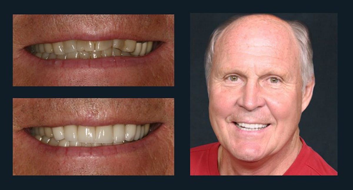 Smile Before & After Gallery - Patient 94064452 - Image 1