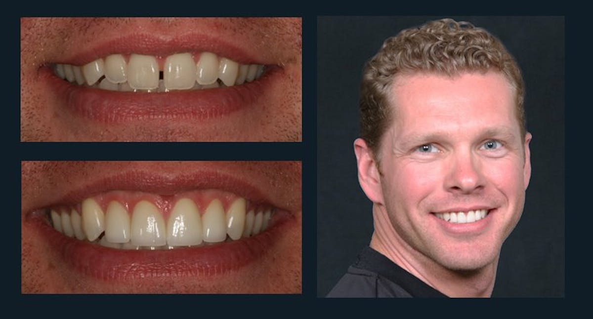 Smile Before & After Gallery - Patient 94064451 - Image 1