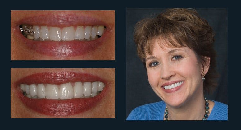 Smile Before & After Gallery - Patient 94064450 - Image 1