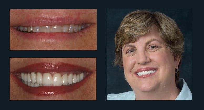 Smile Before & After Gallery - Patient 94064448 - Image 1