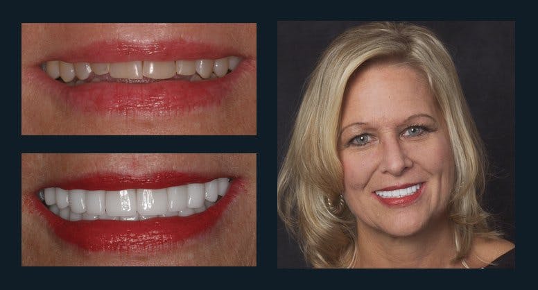Smile Before & After Gallery - Patient 94064447 - Image 1
