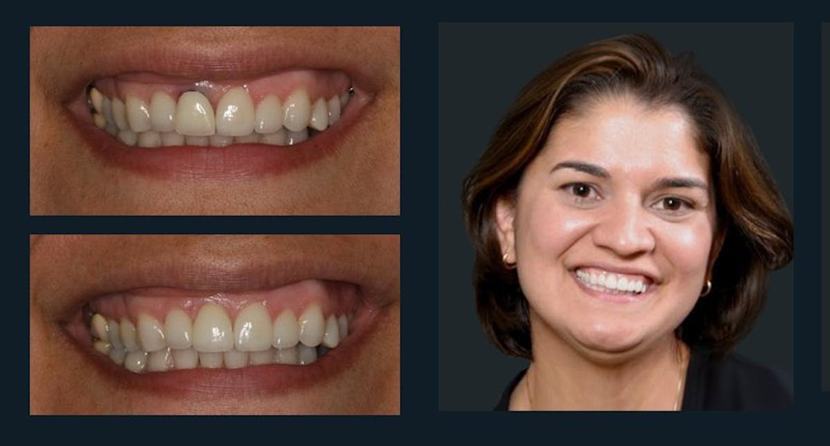 Smile Before & After Gallery - Patient 94064445 - Image 1