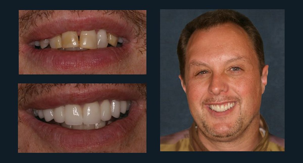 Smile Before & After Gallery - Patient 94064444 - Image 1
