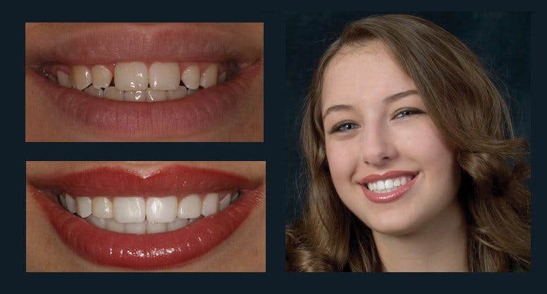 Smile Before & After Gallery - Patient 94064443 - Image 1