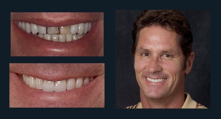 Smile Before & After Gallery - Patient 94064442 - Image 1