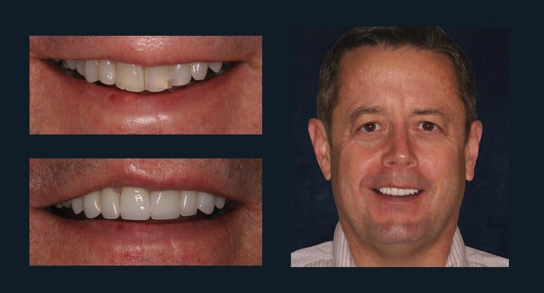 Smile Before & After Gallery - Patient 94064441 - Image 1