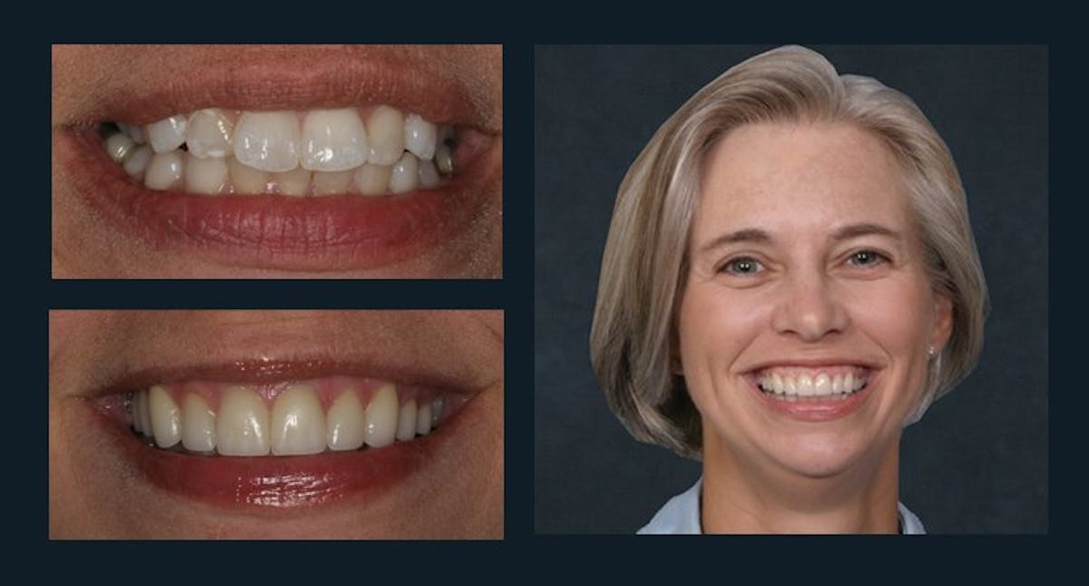 Smile Before & After Gallery - Patient 94064440 - Image 1