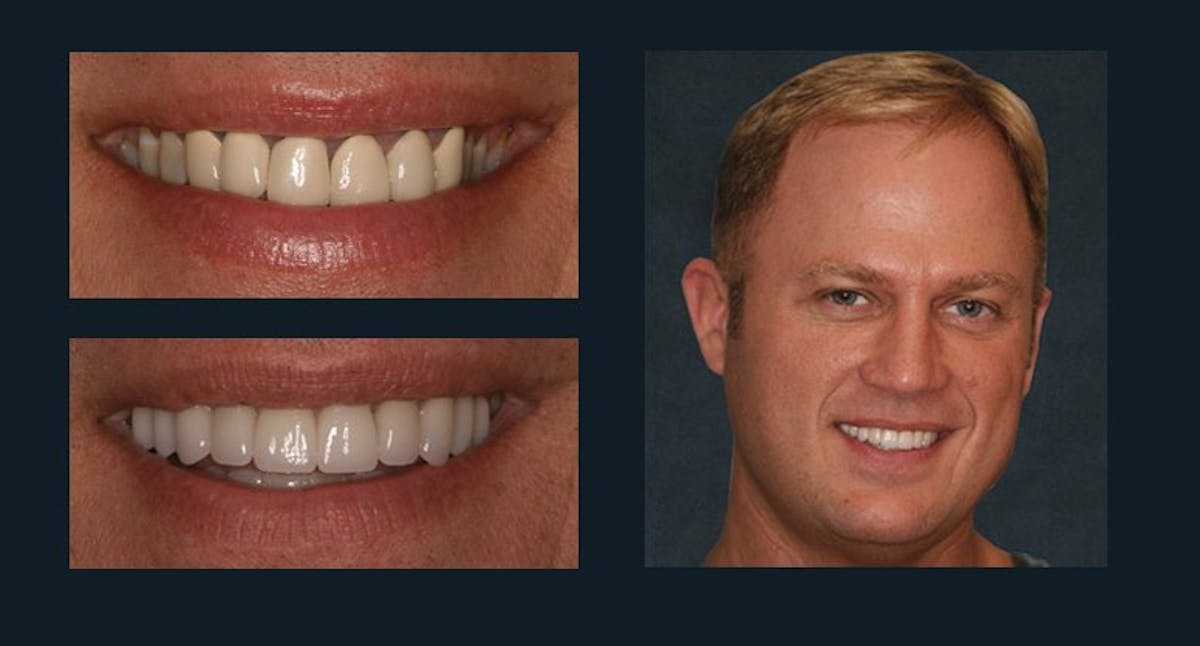 Smile Before & After Gallery - Patient 94064439 - Image 1