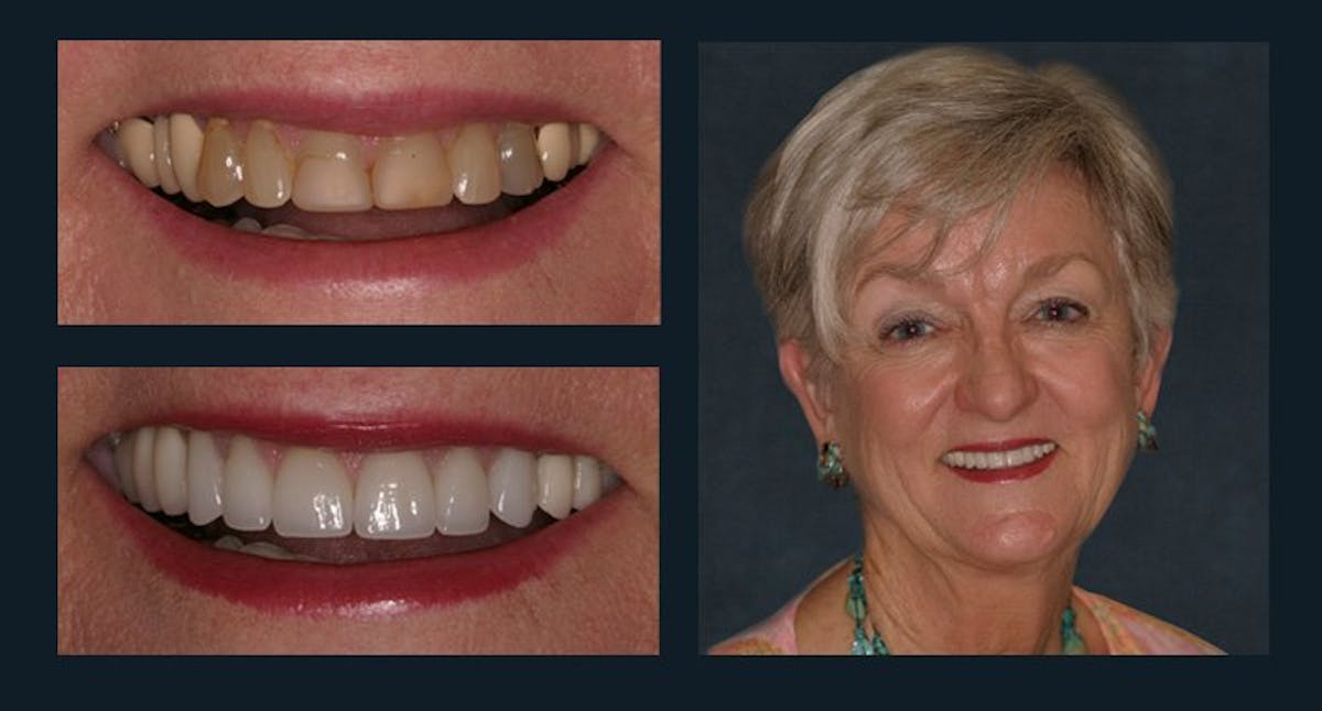 Smile Before & After Gallery - Patient 94064438 - Image 1