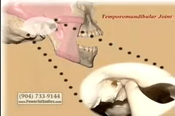 Skull image illustrating TMJ