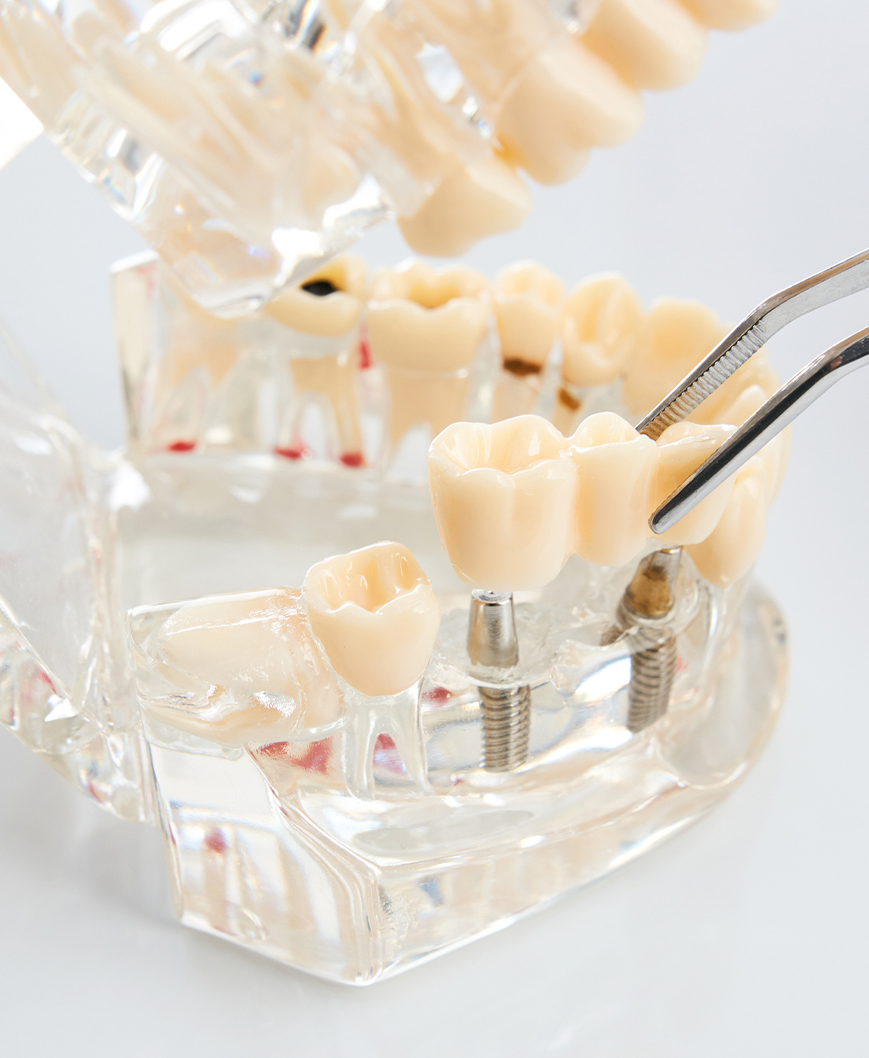 Implant Bridges Admira Dentistry