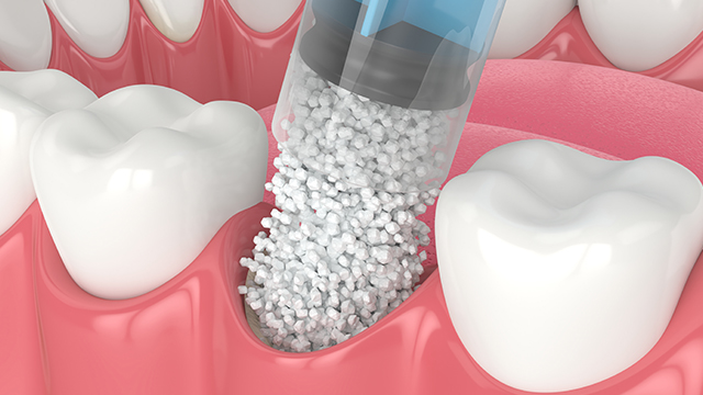 bone grafting illustration