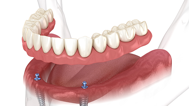 implant-supported dentures