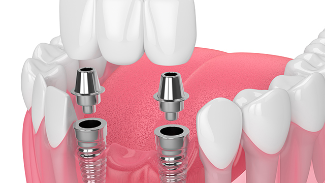 implant bridges