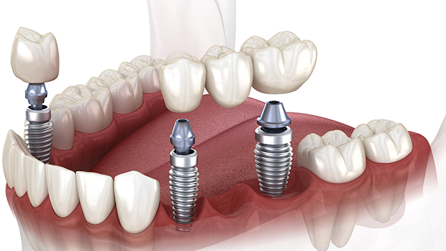 multiple dental implants