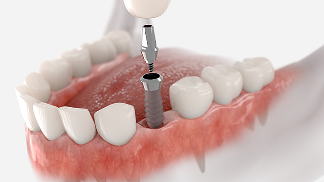 single dental implant 
