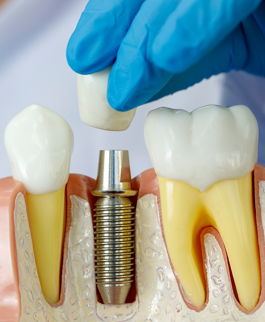 Multiple Dental Implants Admira Dentistry