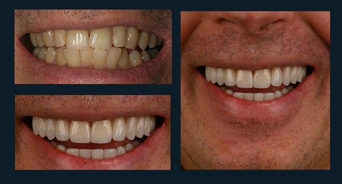 Smile Before & After Gallery - Patient 123127070 - Image 1