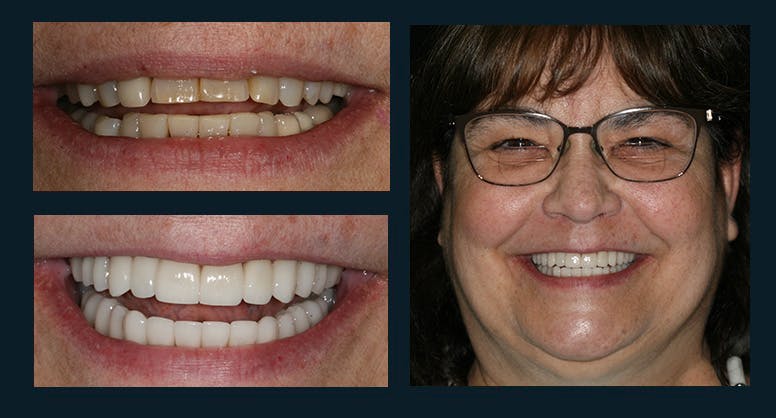 Smile Before & After Gallery - Patient 123127069 - Image 1