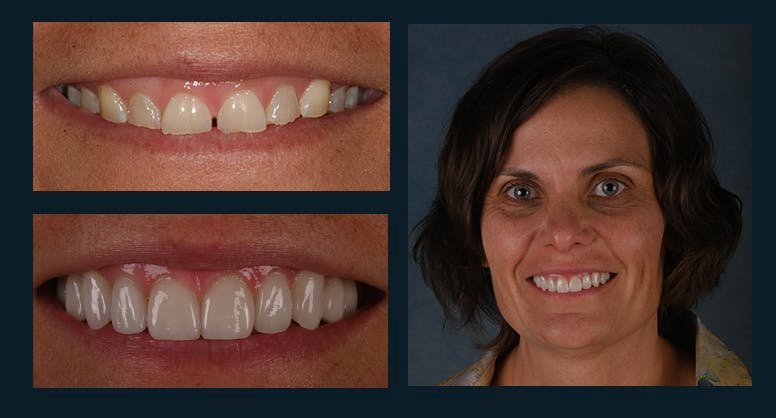 Smile Before & After Gallery - Patient 123127077 - Image 1
