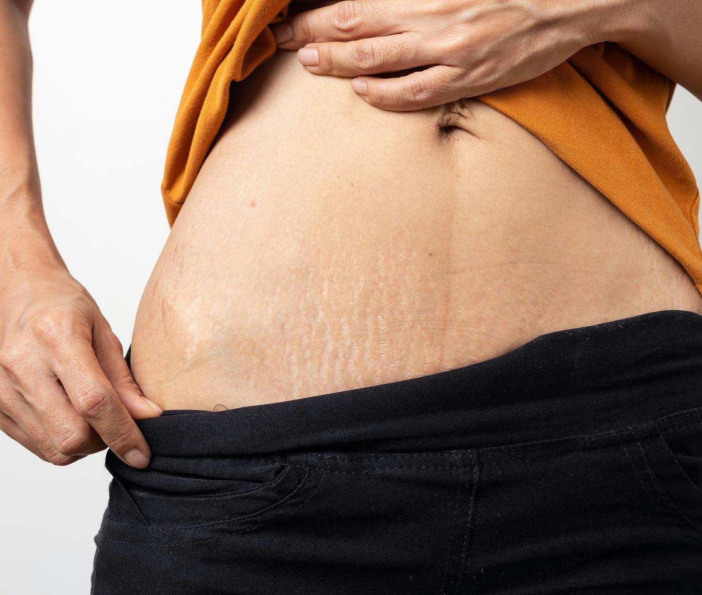 Does tummy tuck remove stretch marks