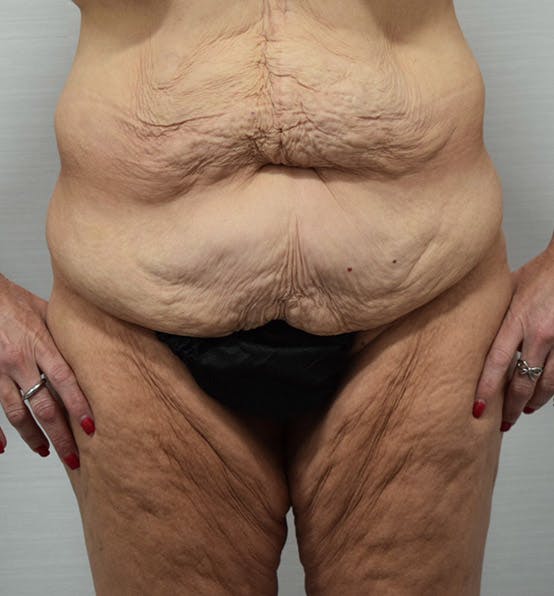 Before and After Photo of a Body Lift in New Jersey