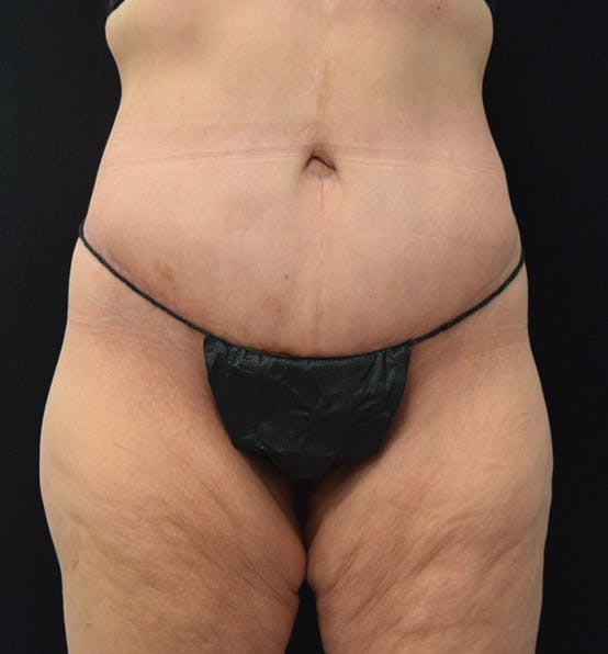 Before and After Photo of a Body Lift in New Jersey