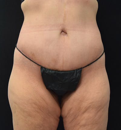 Lower Body Lift Before & After Gallery - Patient 101781870 - Image 2