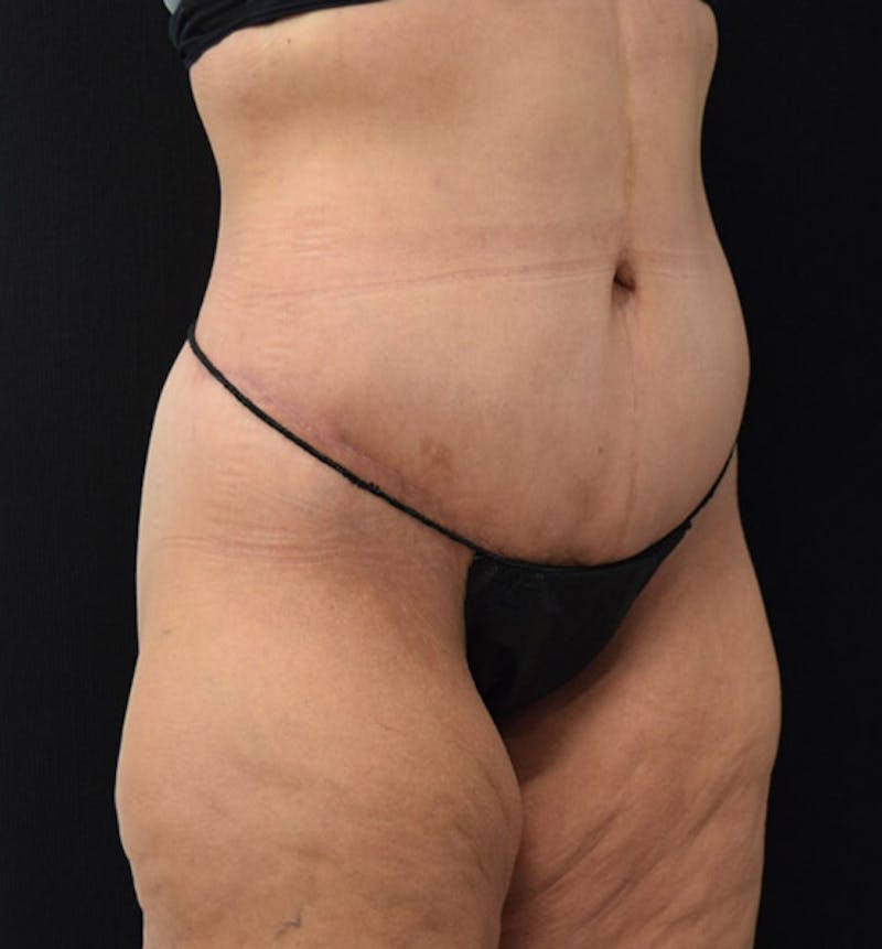 Lower Body Lift Before & After Gallery - Patient 101781870 - Image 4