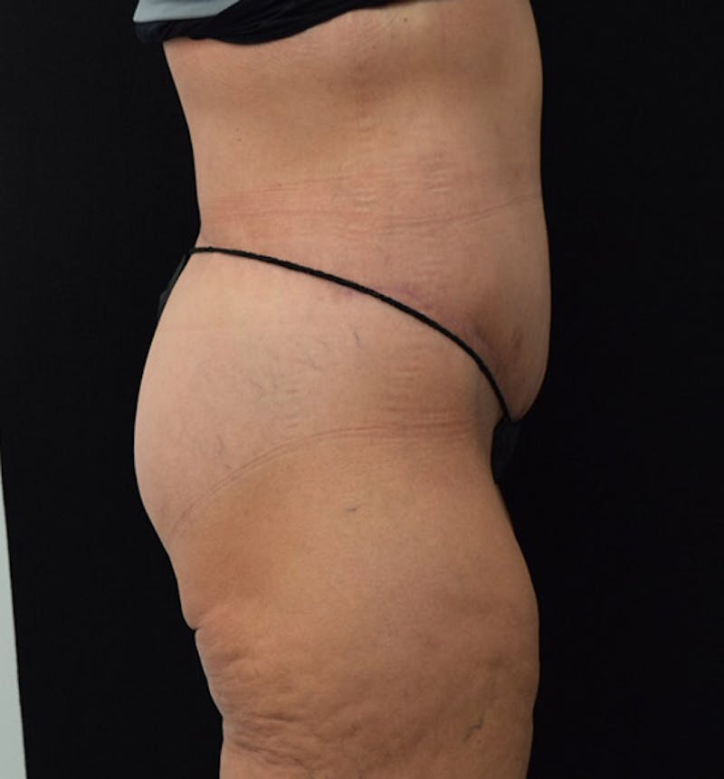 Lower Body Lift Before & After Gallery - Patient 101781870 - Image 6