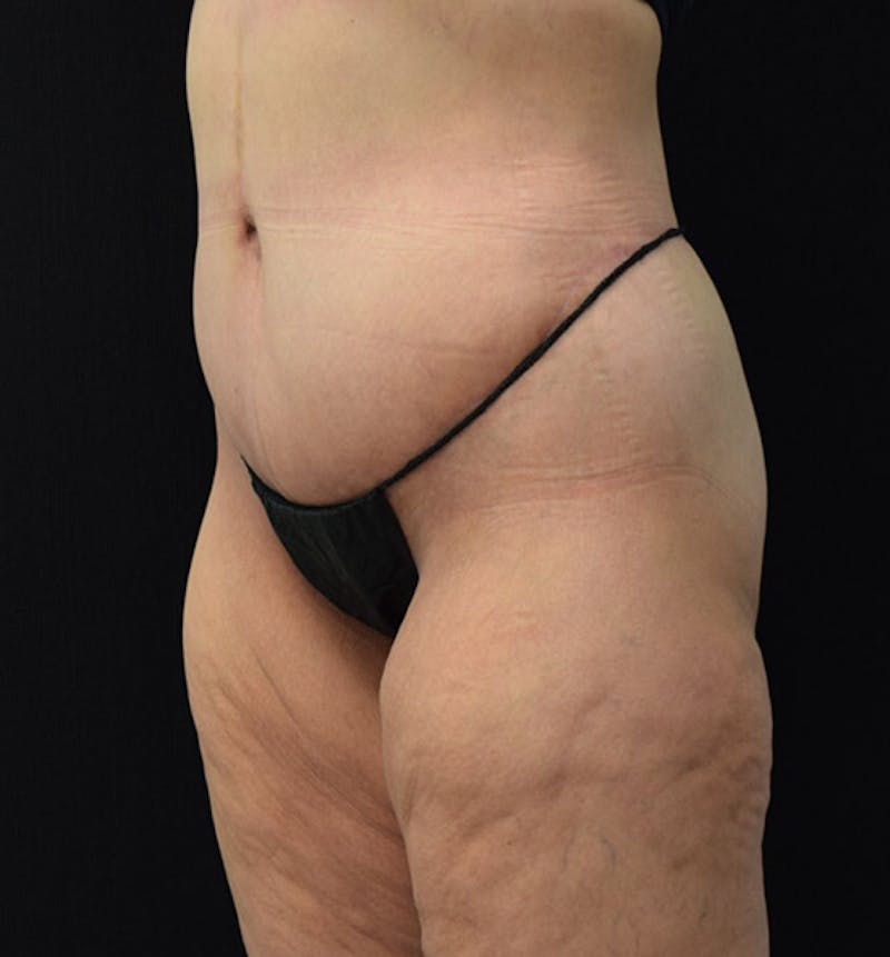 Lower Body Lift Before & After Gallery - Patient 101781870 - Image 8