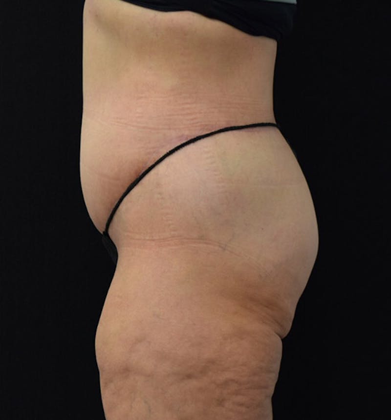 Lower Body Lift Gallery - Patient 101781870 - Image 10