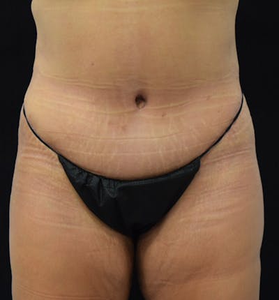Lower Body Lift Before & After Gallery - Patient 101781872 - Image 2